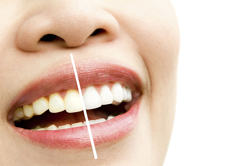Mitos y realidades sobre el blanqueamiento dental✨