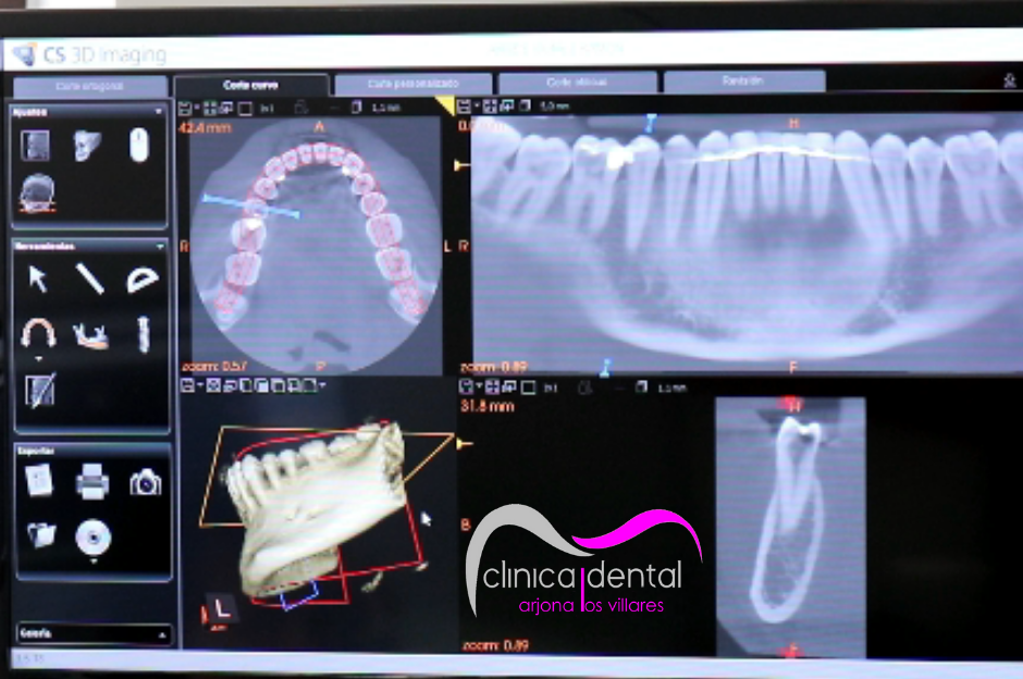 radiografia-3d-resultados-clinica-dental-arjona-los-villares